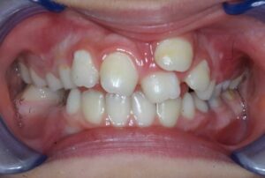 dente sovrannumeraio